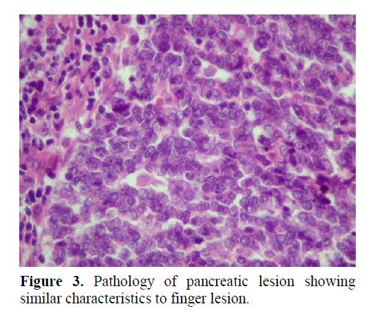 pancreas-pathology-pancreatic-lesion