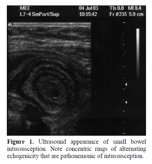 pancreas-pathonemonic-intussusception