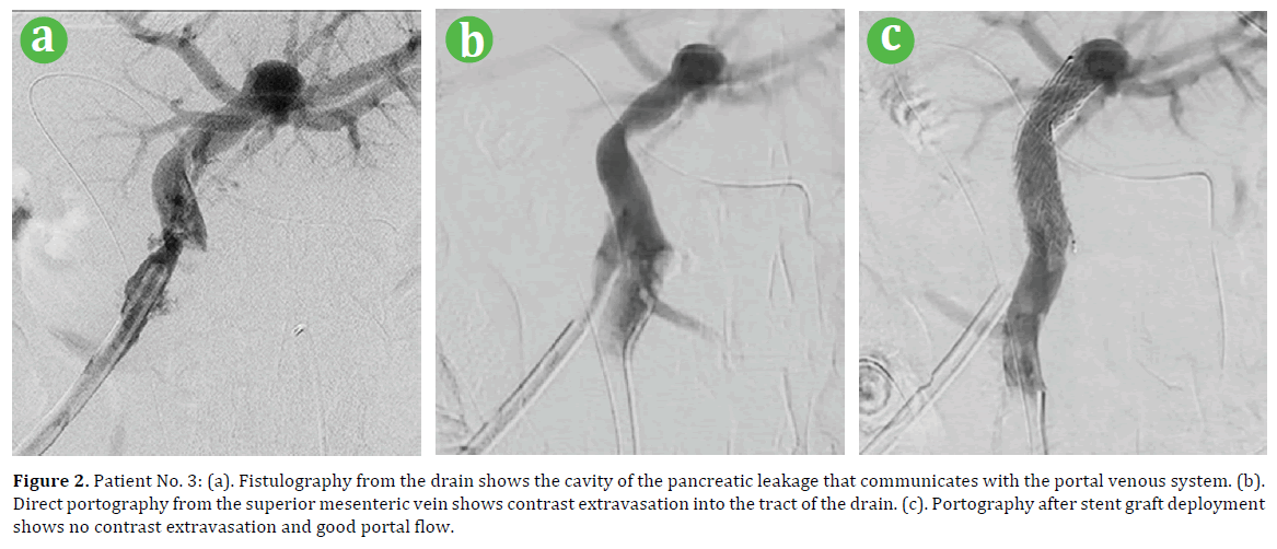 pancreas-patient-fistulography-drain