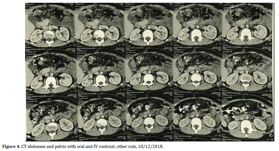 pancreas-pelvis