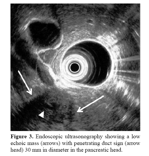 pancreas-penetrating-duct-sign