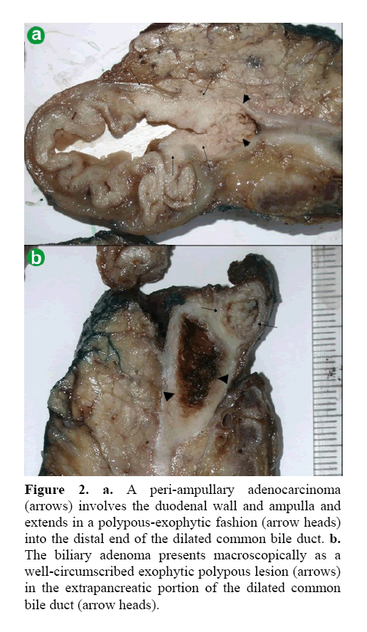 pancreas-peri-ampullary-adenocarcinoma
