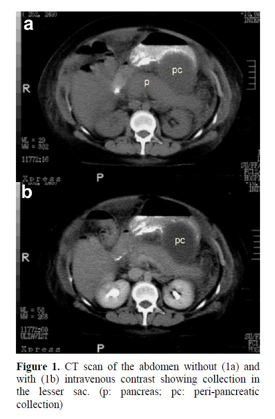 pancreas-peri-pancreatic-collection