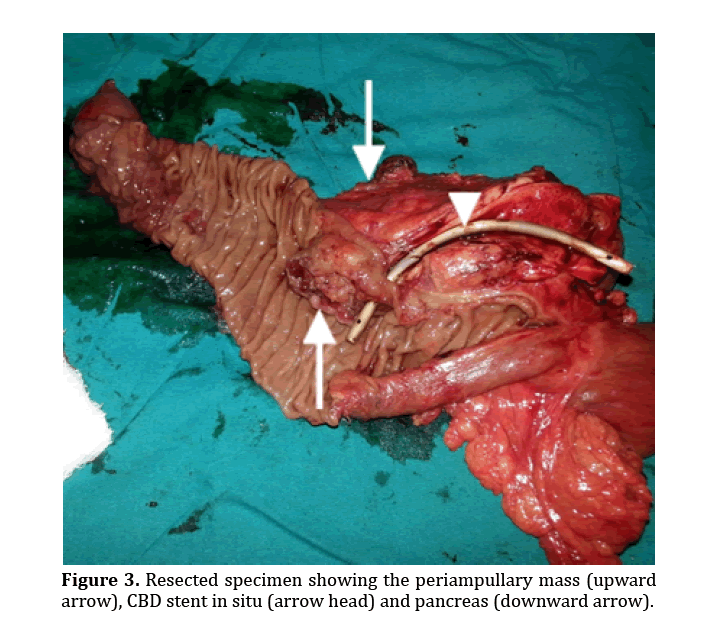 pancreas-periampullary-mass