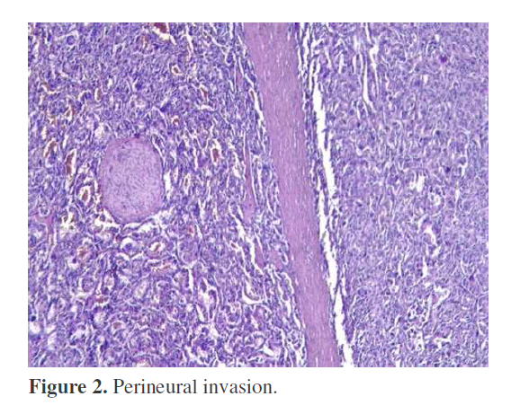 pancreas-perineural-invasion