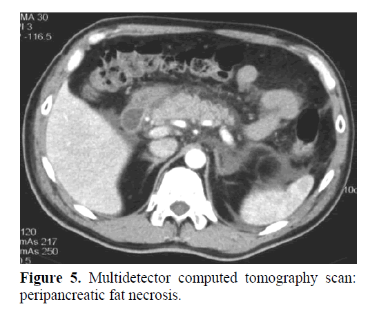 pancreas-peripancreatic-fat-necrosis