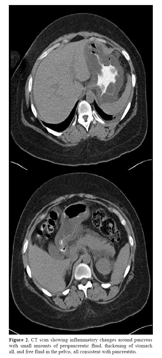 pancreas-peripancreatic-fluid