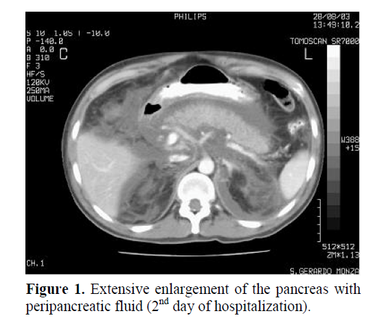 pancreas-peripancreatic-fluid