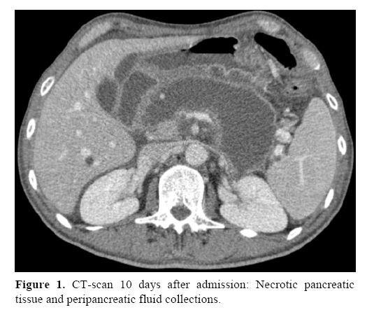 pancreas-peripancreatic-fluid-collections