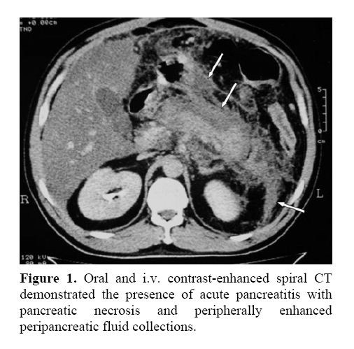 pancreas-peripancreatic-fluid-collections