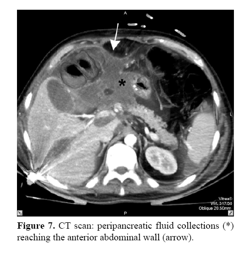 pancreas-peripancreatic-fluid-collections