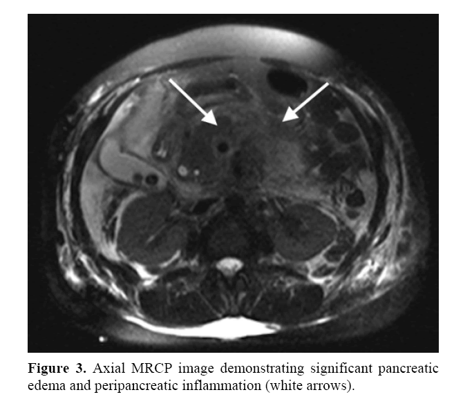 pancreas-peripancreatic-inflammation