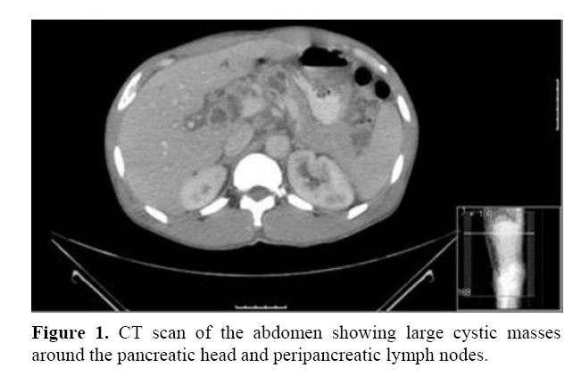 pancreas-peripancreatic-lymph-nodes