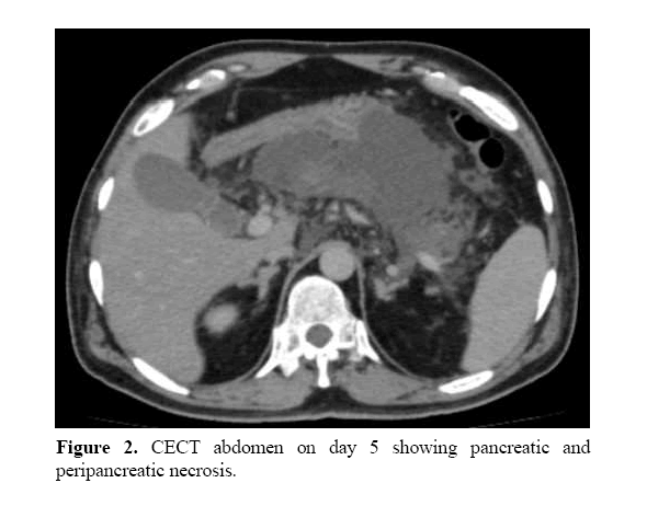 pancreas-peripancreatic-necrosis