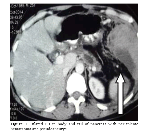 pancreas-perisplenic-hemataoma