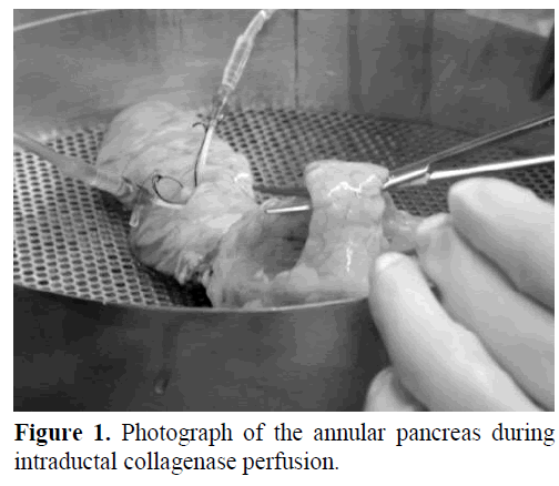 pancreas-photograph-annular-pancreas