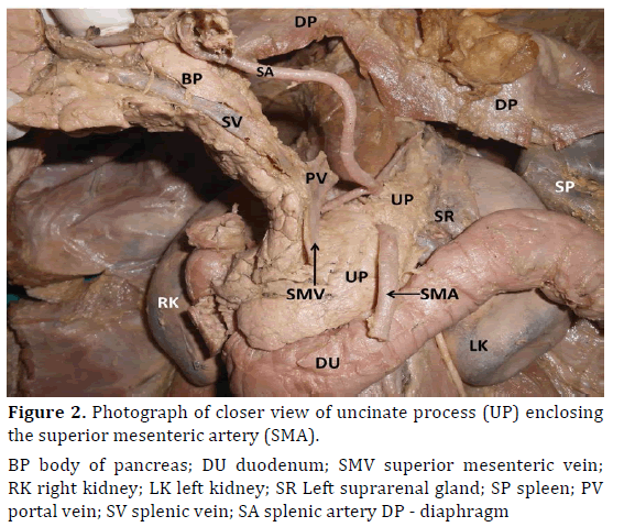 pancreas-photograph-closer-view-uncinate