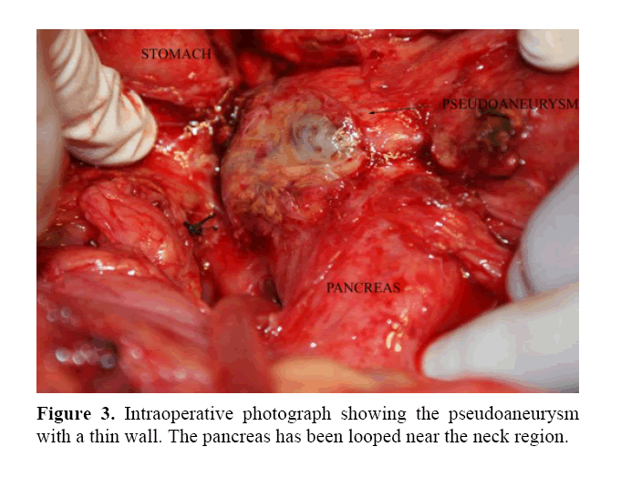 pancreas-photograph-showing-pseudoaneurysm