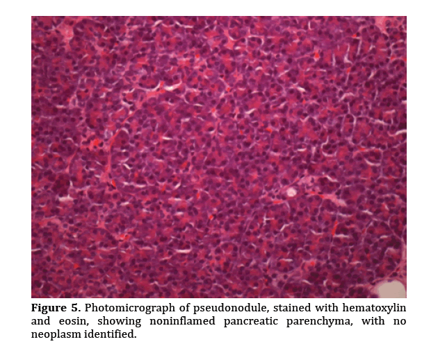 pancreas-photomicrograph-pseudonodule