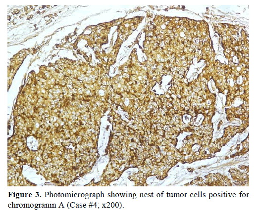 pancreas-photomicrograph-tumor-cells