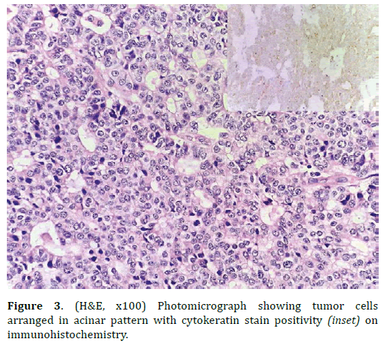 pancreas-photomicrograph-tumor-cells