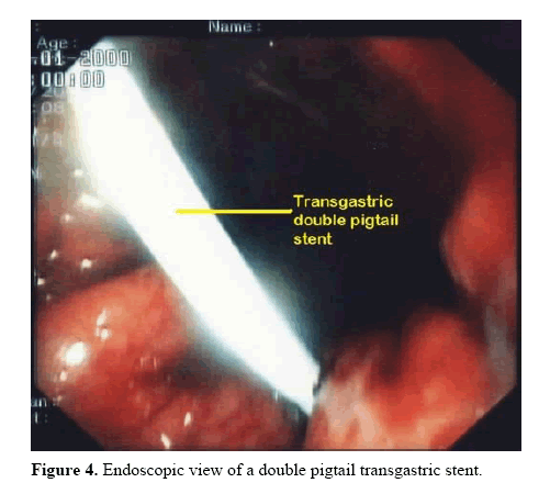 pancreas-pigtail-transgastric-stent