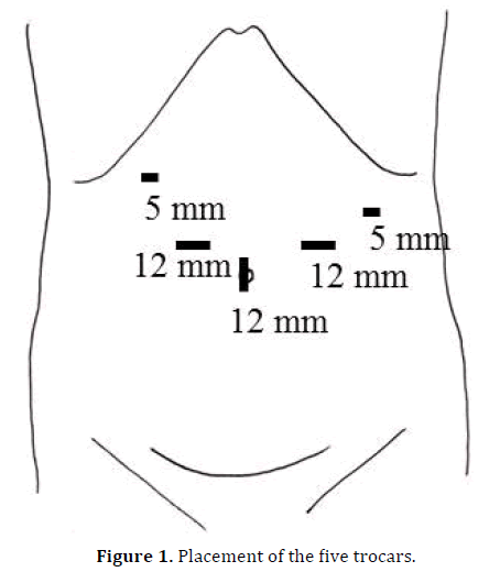 pancreas-placement-five-trocars