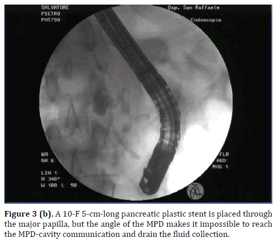 pancreas-plastic-stent