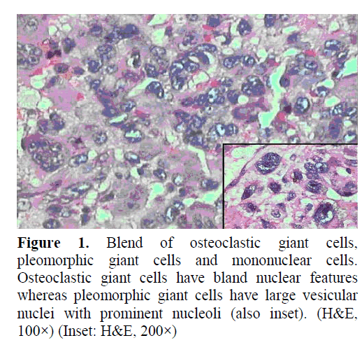 pancreas-pleomorphic-giant-cells