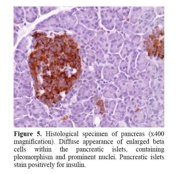 pancreas-pleomorphism-prominent-nuclei