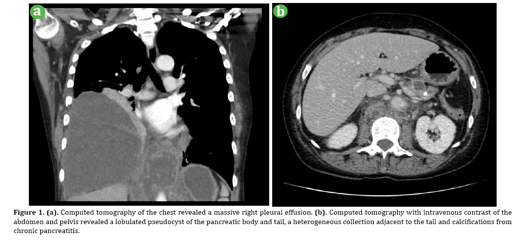 pancreas-pleural-effusion