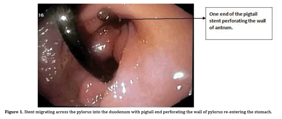 pancreas-pleural-migrating