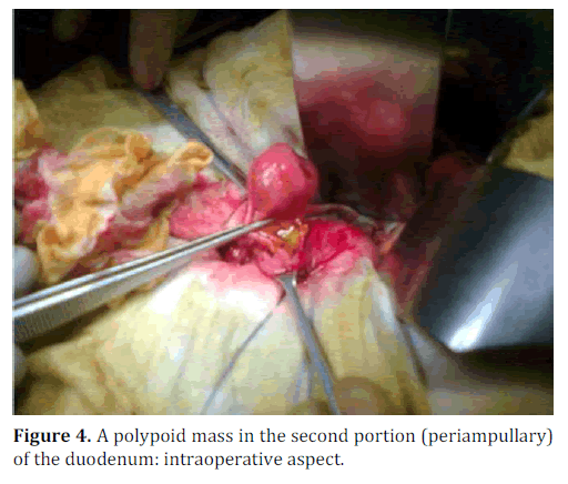 pancreas-polypoid-mass-duodenum