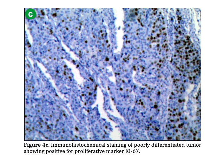 pancreas-poorly-differentiated-tumor
