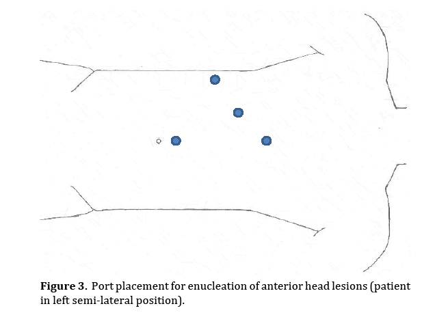 pancreas-port-placement-enucleation