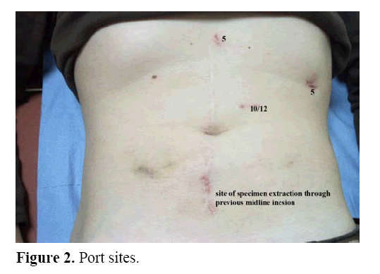 pancreas-port-sites