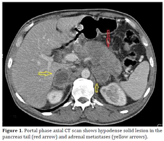 pancreas-portal-hypodense-pancreas