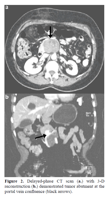 pancreas-portal-vein-confluence