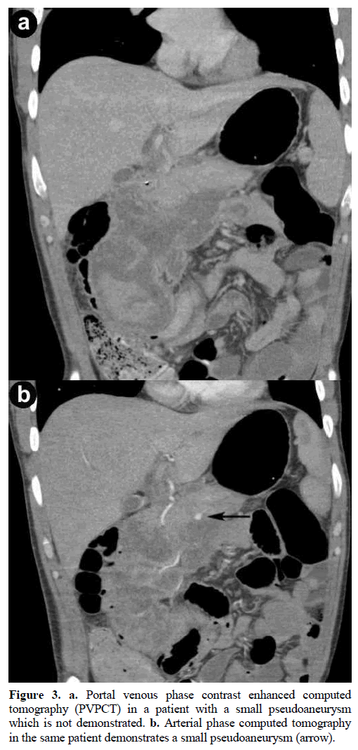 pancreas-portal-venous-phase-contrast