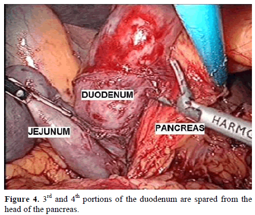 pancreas-portions-duodenum-pancreas