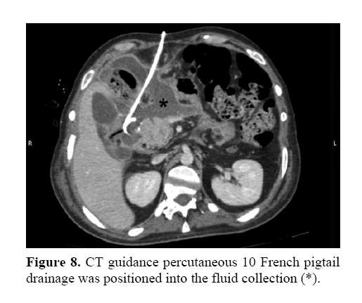 pancreas-positioned-fluid-collection