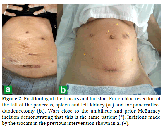 pancreas-positioning-trocars-incision