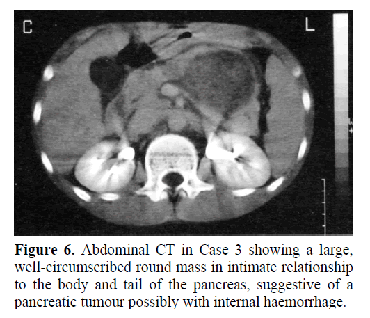 pancreas-possibly-internal-haemorrhage