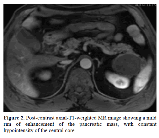 pancreas-post-contrast-axial-t1-weighted