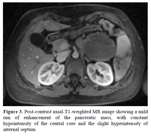 pancreas-post-contrast-axial-t1-weighted