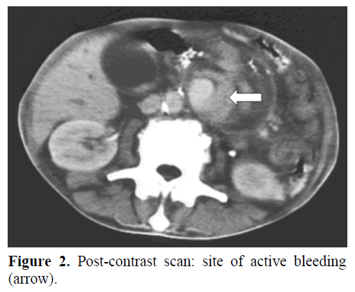 pancreas-post-contrast-scan