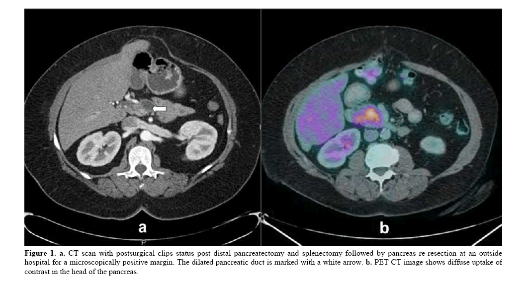 pancreas-post-distal-pancreatectomy