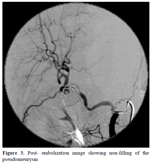 pancreas-post-embolization-image