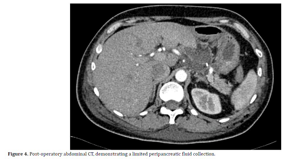 pancreas-post-operatory-abdominal