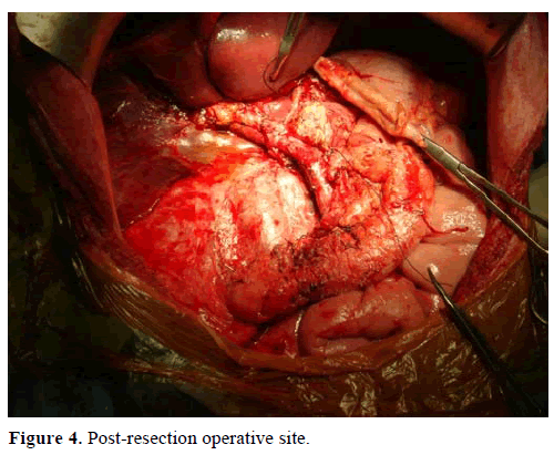 pancreas-post-resection-operative-site